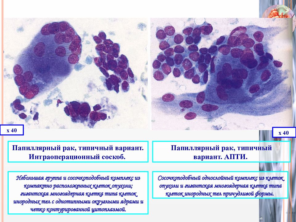 Цитологическая картина фолликулярной опухоли щитовидной железы что значит