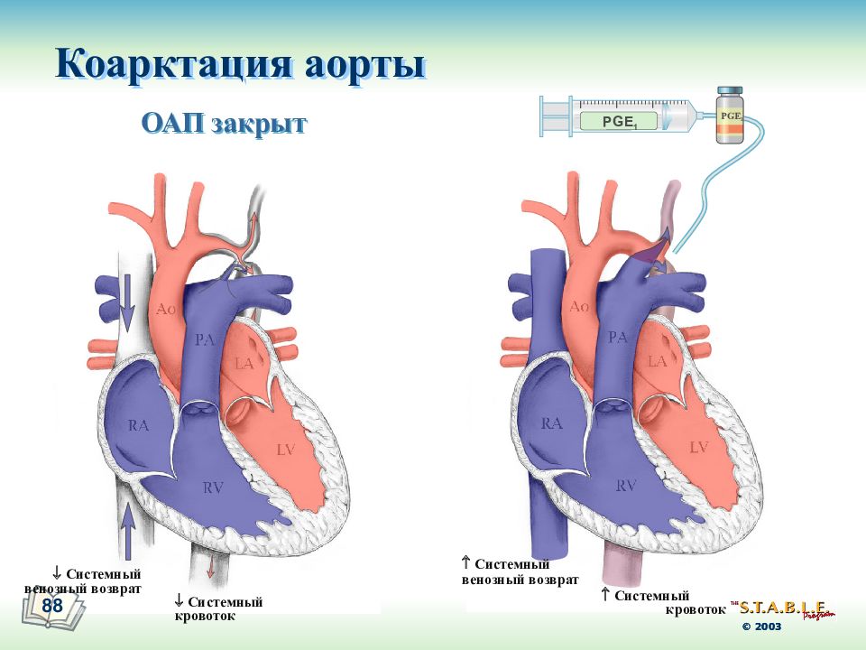 Коарктация аорты гемодинамика схема