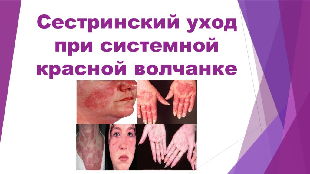 Сестринский уход при системной красной волчанке