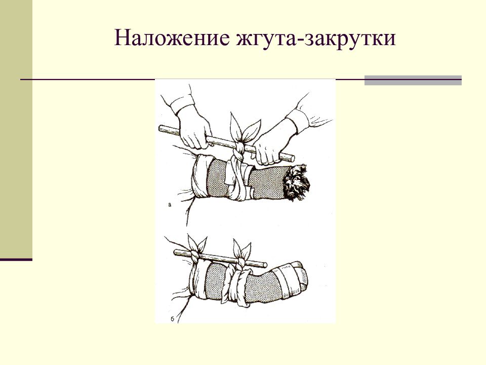 Наложение жгута. Наложение жгута закрутки. Наложение кровоостанавливающего жгута закрутки. Наложение жгута щакрутка. Техника наложения жгута закрутки.