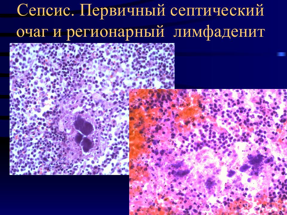 Чума патологическая анатомия презентация