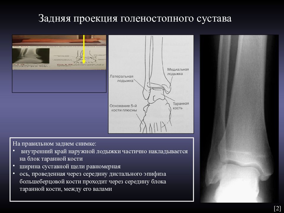 Суставная щель голеностопного сустава. Большеберцовая кость рентген анатомия. Рентген анатомия голеностопного устава. Рентгеноанатомия большеберцовой кости. Рентгеноанатомия нижней конечности.