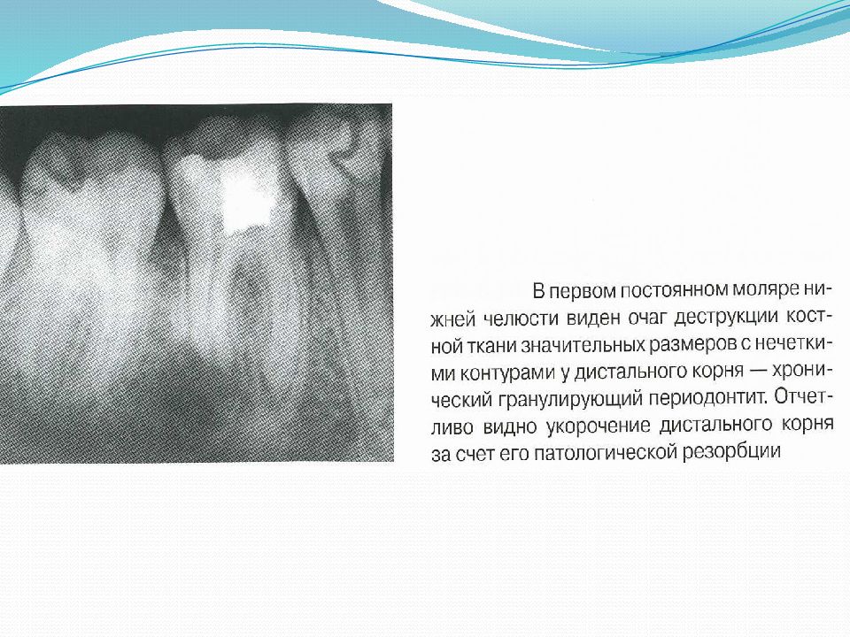 Ошибки и осложнения при лечении периодонтита. Презентация на тему периодонтит. Гранулирующий периодонтит у детей. Лечение периодонтита постоянных зубов. Периодонтиты постоянных зубов у детей.