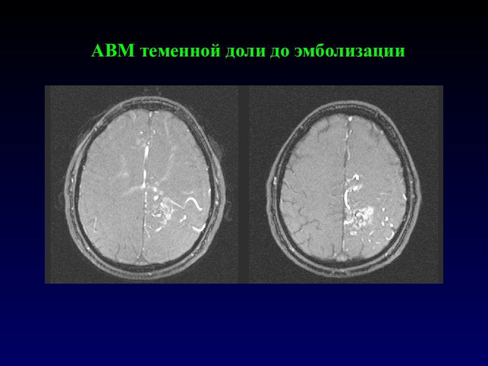 Венозная мальформация лобной доли. Венозная мальформация теменной доли. Венозная мальформация теменной доли головы.