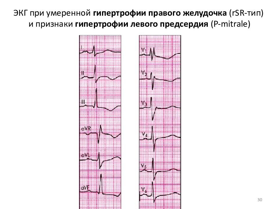 Экг левое предсердие. ЭКГ при гипертрофии левого правого желудочка. RSR Тип гипертрофии правого желудочка. Гипертрофия правого желудочка на ЭКГ RSR. Признаки гипертрофии правого желудочка на ЭКГ.