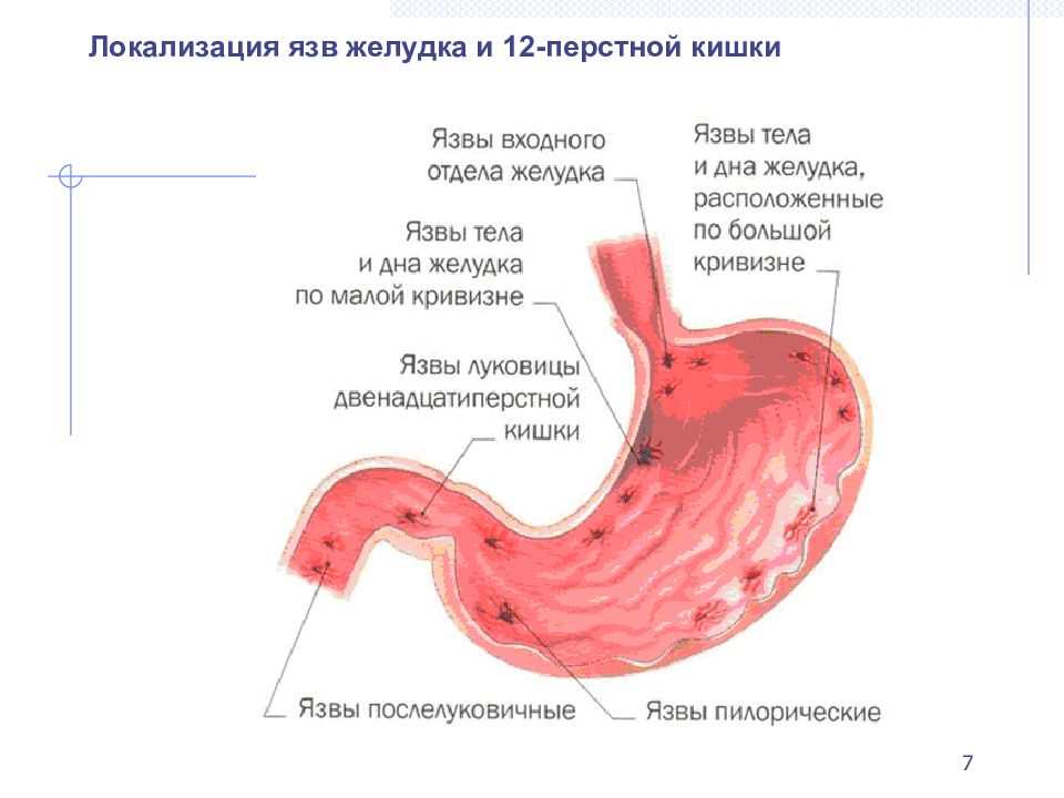 Ябж и 12 перстной кишки