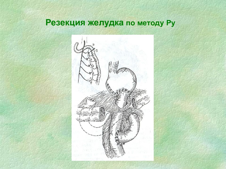 Метод ru. Оперативные вмешательства выполняемые на желудке. Оперативный доступ для резекции желудка. Резекция по методике ноузис. Гастрэктомия по орру-ханту-Накаяме,.