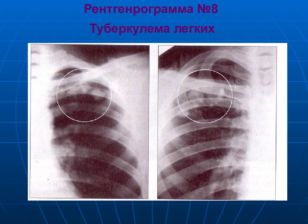 операция туберкулемы