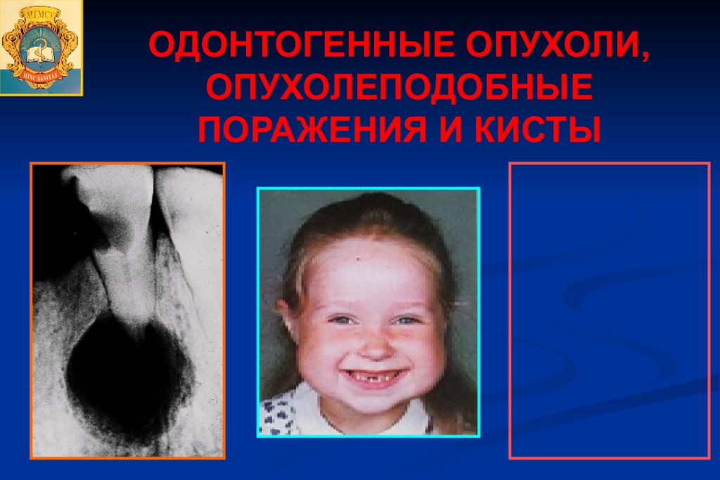 ОДОНТОГЕННЫЕ ОПУХОЛИ, ОПУХОЛЕПОДОБНЫЕ ПОРАЖЕНИЯ И КИСТЫ