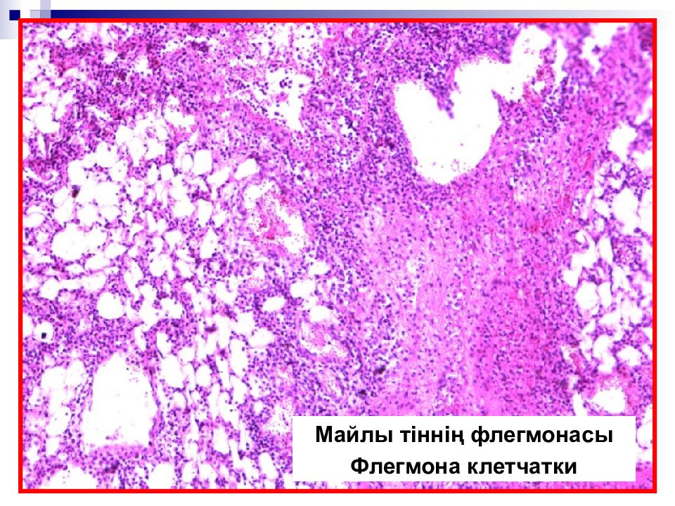 Воспаление клетчатки. Флегмона мягких тканей микропрепарат. Флегмона кожи микропрепарат. Флегмона микропрепарат. Флегмона мышцы микропрепарат.