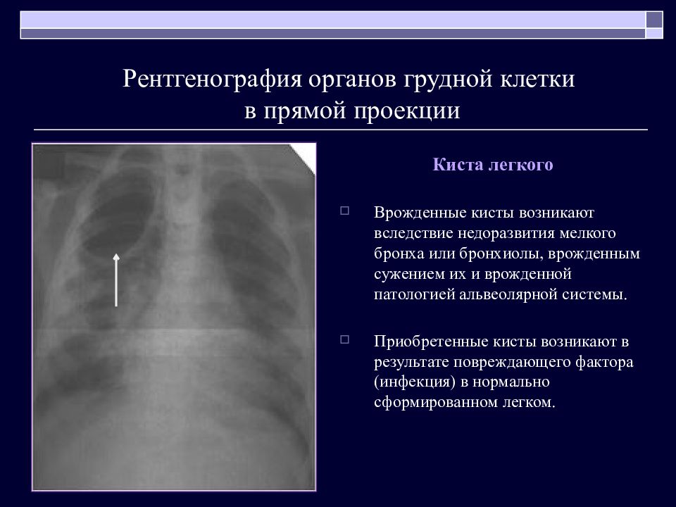 Кисты легких у детей презентация