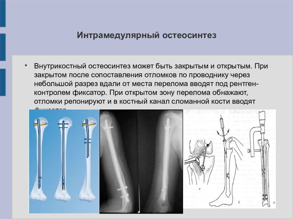 Стержень остеосинтез. Внеочаговый аппаратный остеосинтез. Внутрикостный остеосинтез показания. Внутрикостный остеосинтез ключицы. Внутрикостный остеосинтез ретроградный.