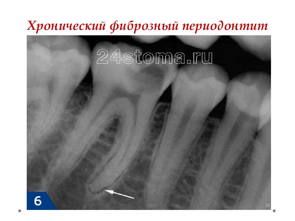 Фиброзный периодонтит. Фиброзный периодонтит рентген. Хронический фиброзный периодонтит рентген. Фиброзным, гранулирующем периодонтите. Острый апикальный периодонтит рентген.