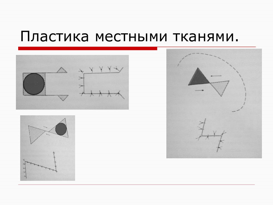 Презентация пластика местными тканями