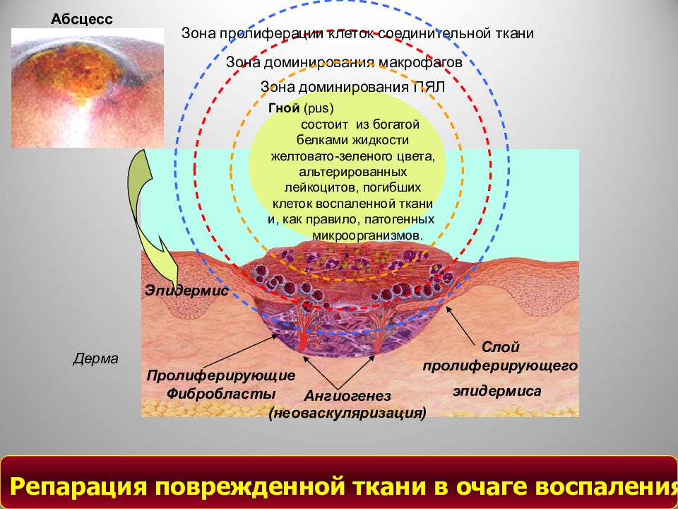 Воспаление 3. Патогенез хронического воспаления. Патогенез воспаления 3.