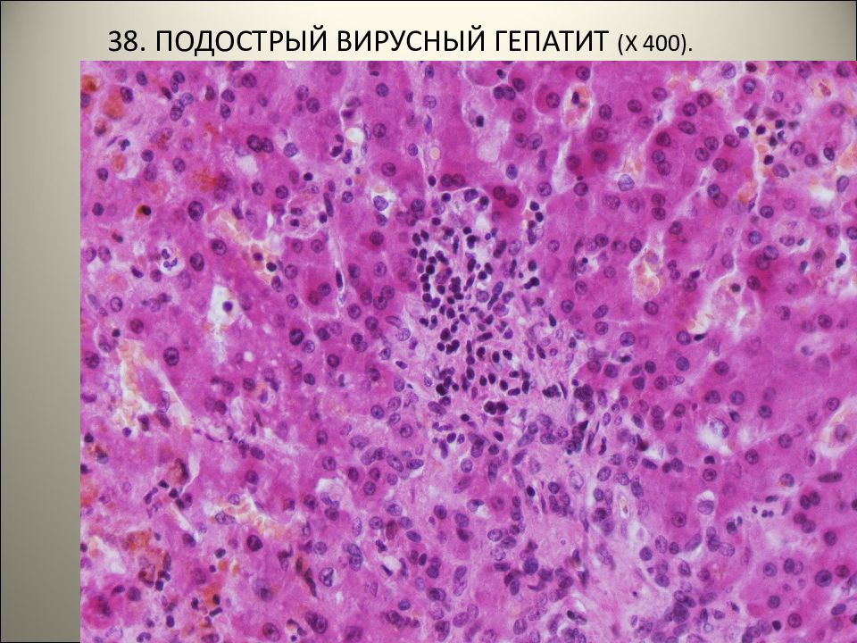 Заболеванием 16. Эктоцервицит подострый. Подострый гепатит с массивным некрозом. Подострый гранулематозный, подострый лимфоцитарный. Болезни желудочно-кишечного гепатит.