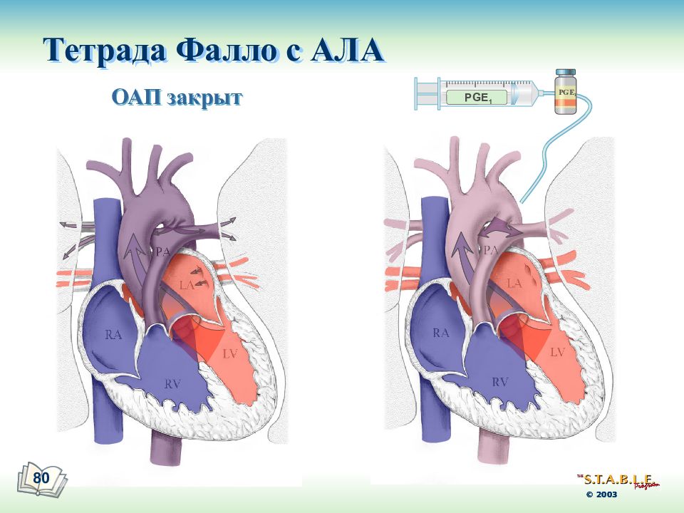 Тетрада фалло лечение