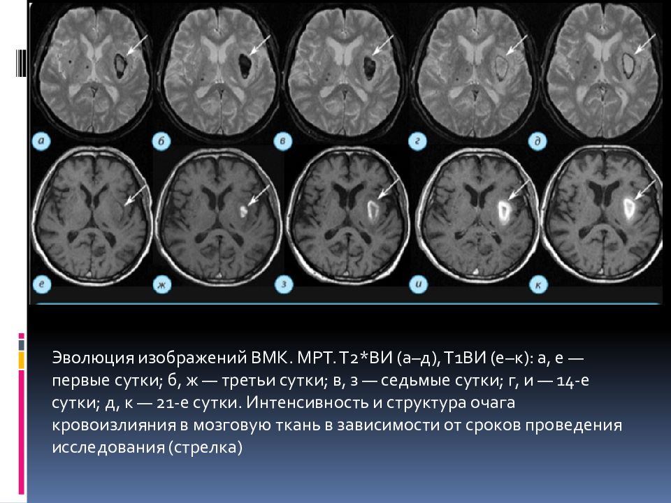 Инсульт на мрт головного мозга картинки