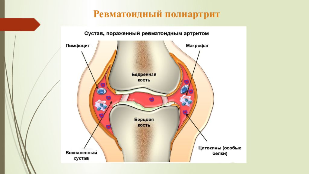 Ревматический полиартрит. Ревматоидный полиартрит. Ревматоидный полиартрит презентация. Сестринский процесс при ревматоидном полиартрите.