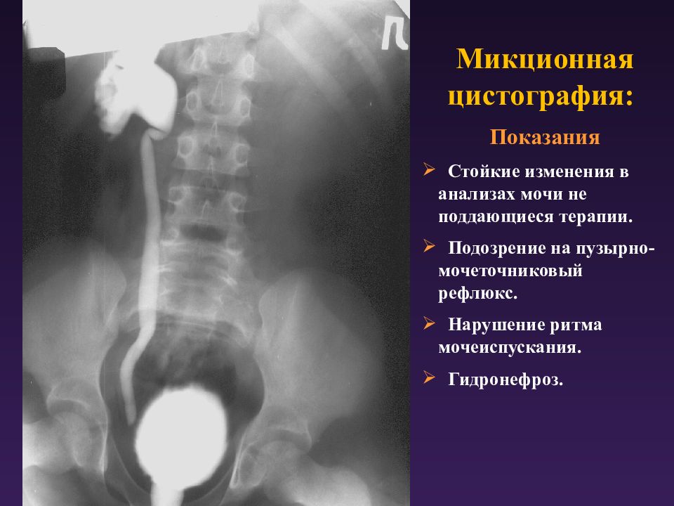 Микционная цистография фото