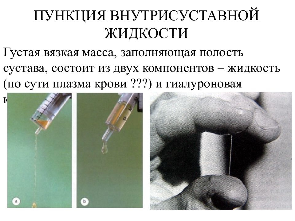 Полость заполнена жидкостью. Презентация на тему пункции. Внутрисуставная пункция.