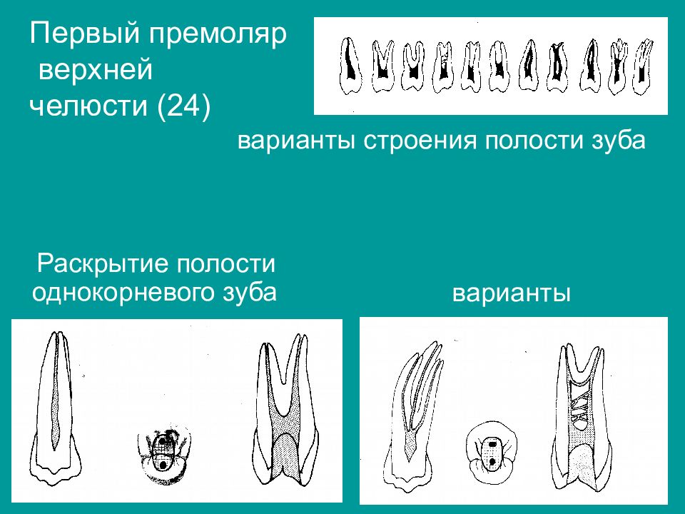 1 премоляр нижней челюсти. Зуб 1 премоляр верхней челюсти. Раскрытие полости премоляров. Первый премоляр верхней челюсти полость. Раскрытие полости премоляров верхней.