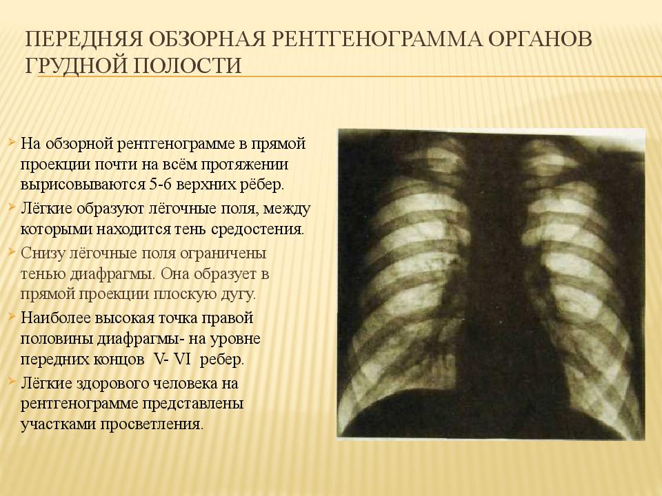Передняя обзорная рентгенограмма органов грудной полости