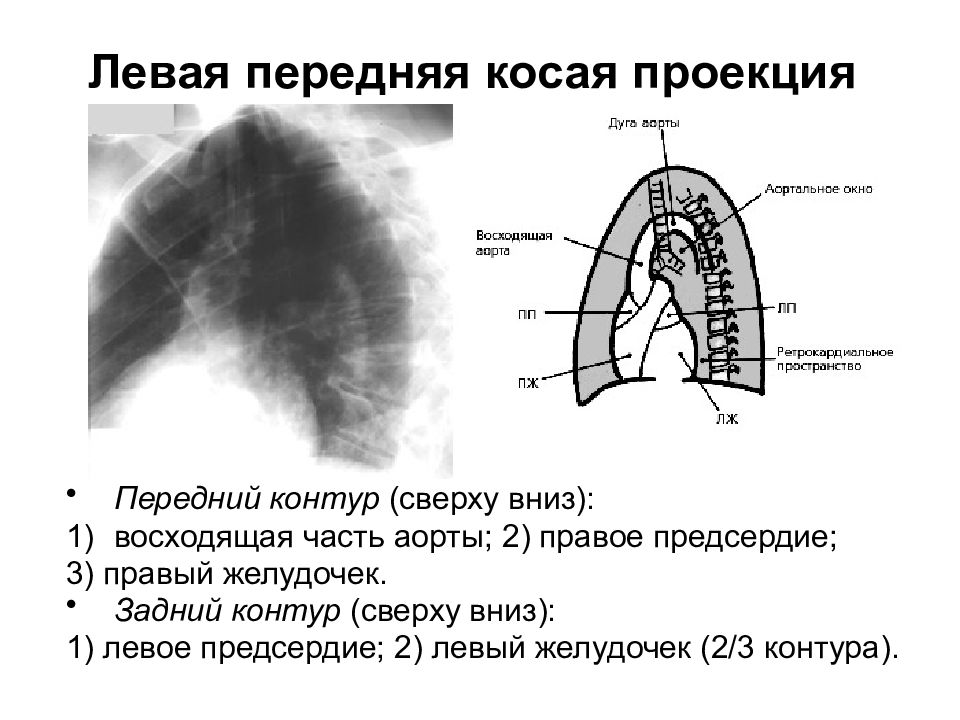 Косая проекция. Левая косая проекция рентгенограмма. Левая косая проекция сердца. Передняя косая проекция. Правая косая проекция сердца.