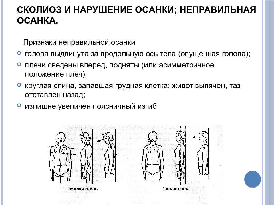 Главной нарушении осанки является. Нарушение осанки сколиоз. Признаки нарушения осанки. Профилактика дефектов осанки. Выявление нарушения осанки у детей.