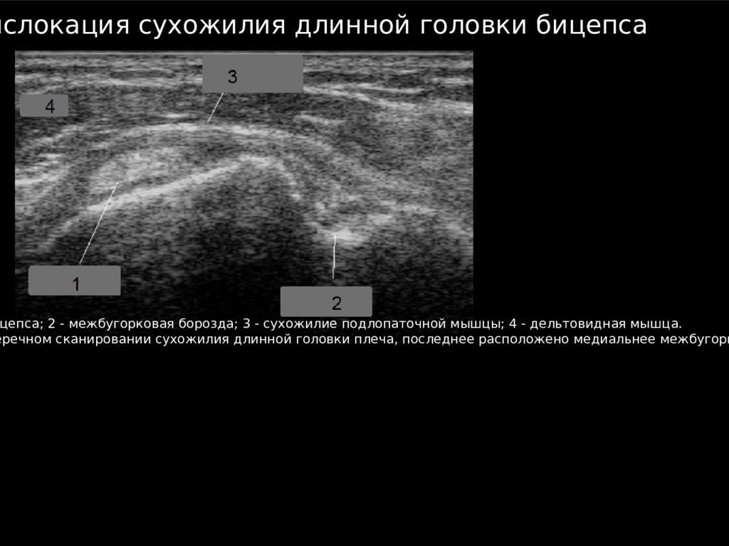 Узи плечевого. УЗИ отрыв сухожилия двуглавой мышцы. Разрыв сухожилия двуглавой мышцы плеча на УЗИ. Разрыв сухожилия длинной головки бицепса УЗИ. Тендинит сухожилия длинной головки бицепса на УЗИ.
