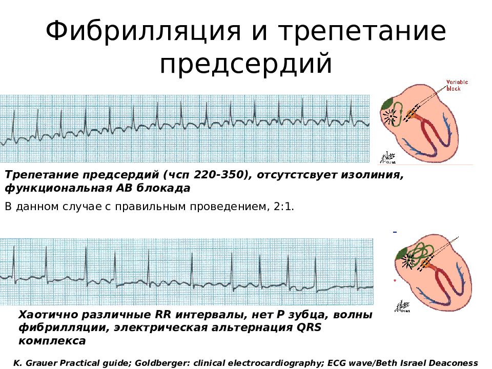 Фибрилляция предсердий что. Трепетание и фибрилляция предсердий на ЭКГ. Фибрилляция предсердий и трепетание предсердий различия. Фибрилляция и трепетание разница. Фибрилляция предсердий интерпретация ЭКГ.