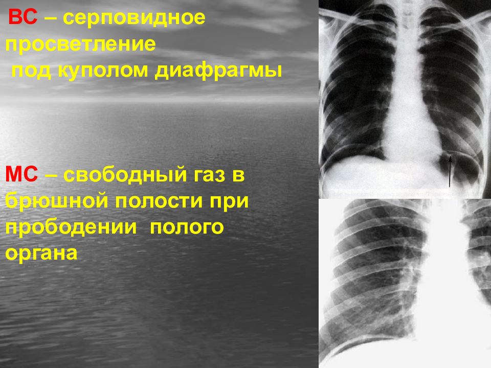 Свободный газ. Свободный ГАЗ В брюшной полости. Свободный ГАЗ под диафрагмой. Свободный ГАЗ под куполом диафрагмы. Свободный ГАЗ В брюшной полости при прободной язве желудка.