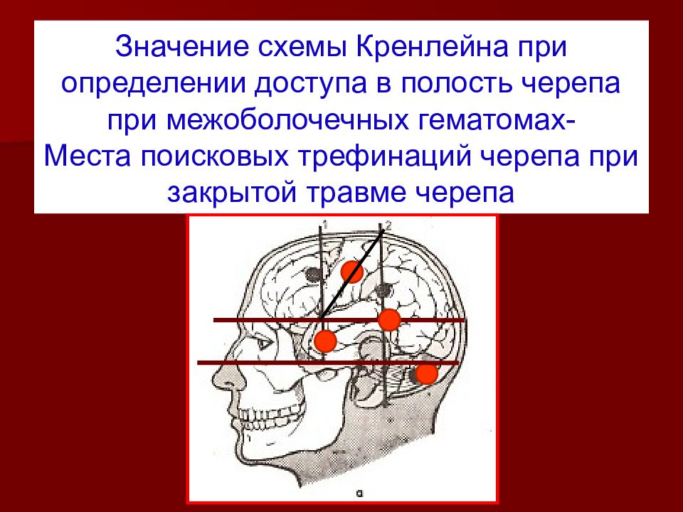 Схема кренлейна для чего