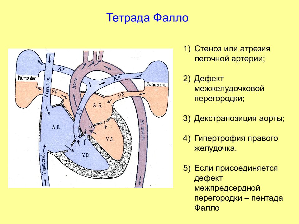 Стеноз легочной артерии. Триада Тетрада пентада Фалло. Тетрада Фалло с атрезией легочной артерии 1 Тип. Дефект межпредсердной перегородки желудочка. Тетрада Фалло гемодинамика схема.