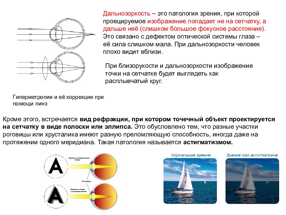 Оптическая система глаза строит изображение далеких предметов перед сетчаткой