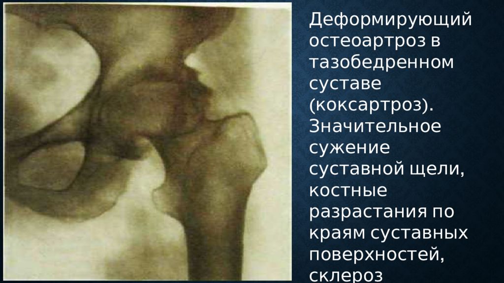 Склероз и краевые остеофиты. Костные остеофиты тазобедренного сустава. Деформирующий остеоартроз рентген тазобедренного сустава. Остеофиты тазобедренного сустава рентген.