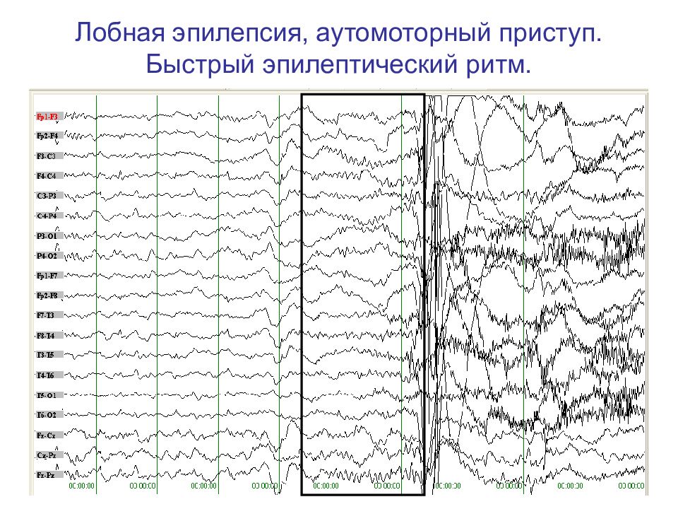 Ээг эпилепсия картинки