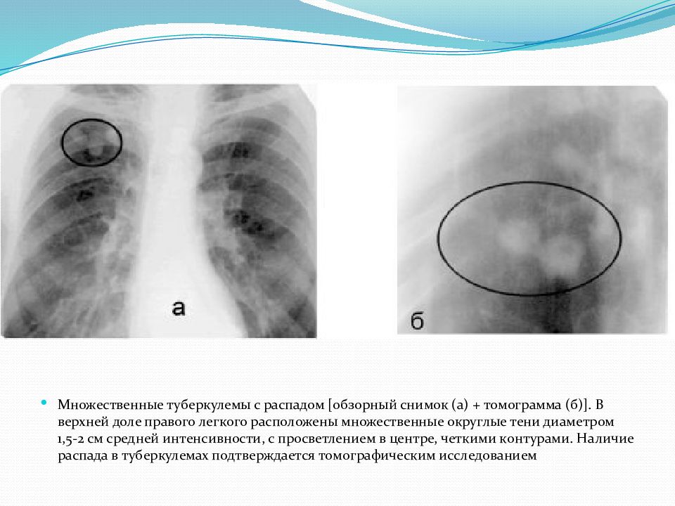 Презентация туберкулема легких