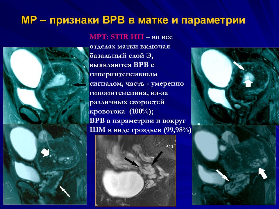 Расширение вен матки