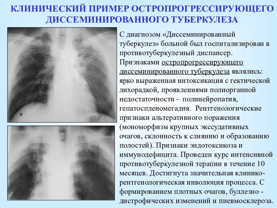 Рецидивы после туберкулеза