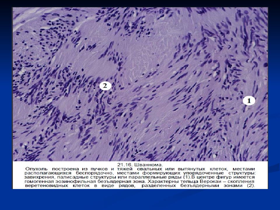 Мезенхимальные опухоли патанатомия презентация
