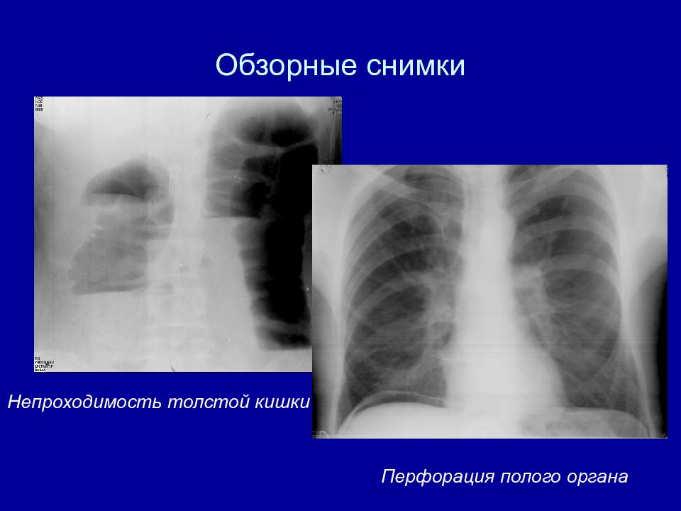 Возникновение сквозного дефекта в стенке полого органа