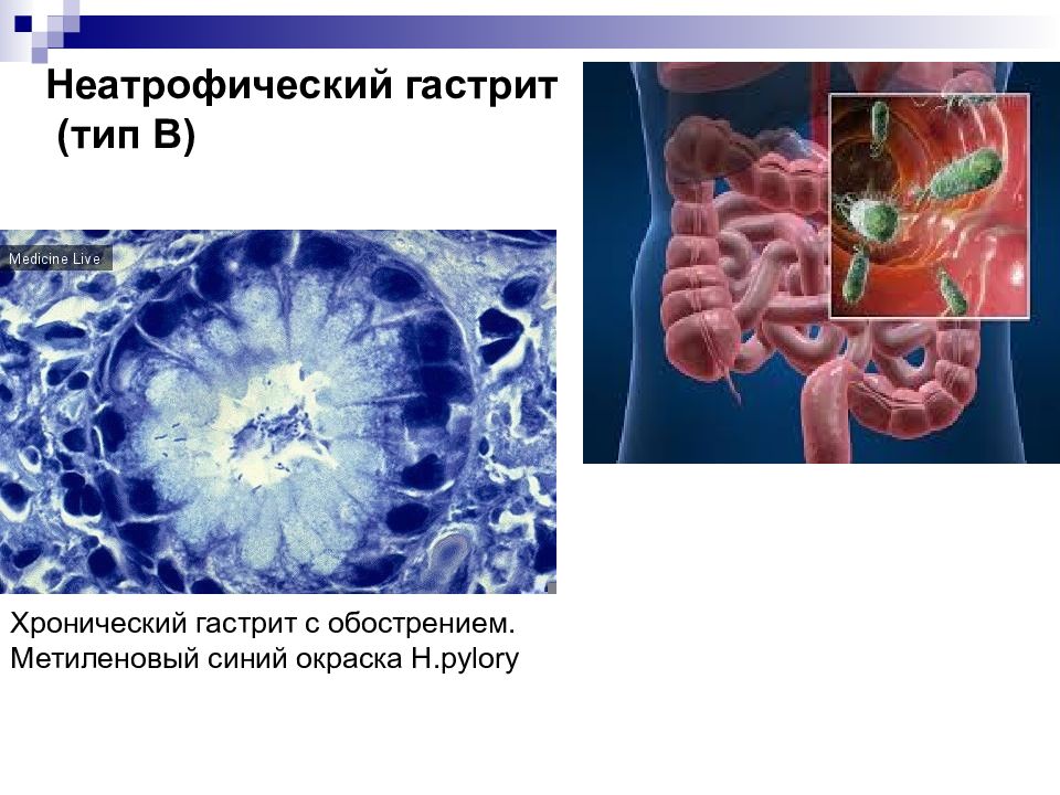 Болезням 38. Неатрофический гастрит. Хронический неатрофический гастрит. Неатрофический антральный гастрит это. Хронический неатрофический гастрит (Тип в).