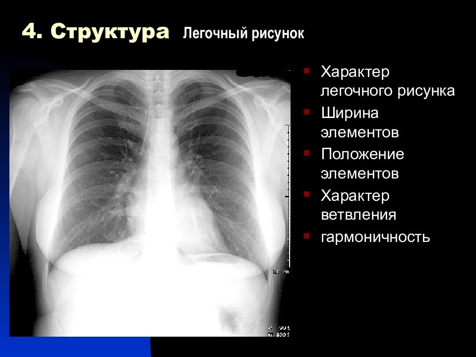 Типы легочного рисунка. Рентген легких анатомия. Характер легочного рисунка. Рентгеновская анатомия сердца. Рентген анатомия сердца.