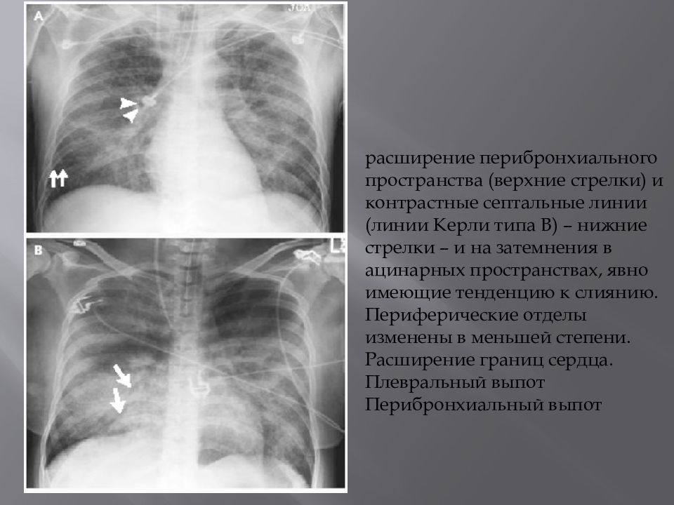 Рентгенологическая картина отека легких