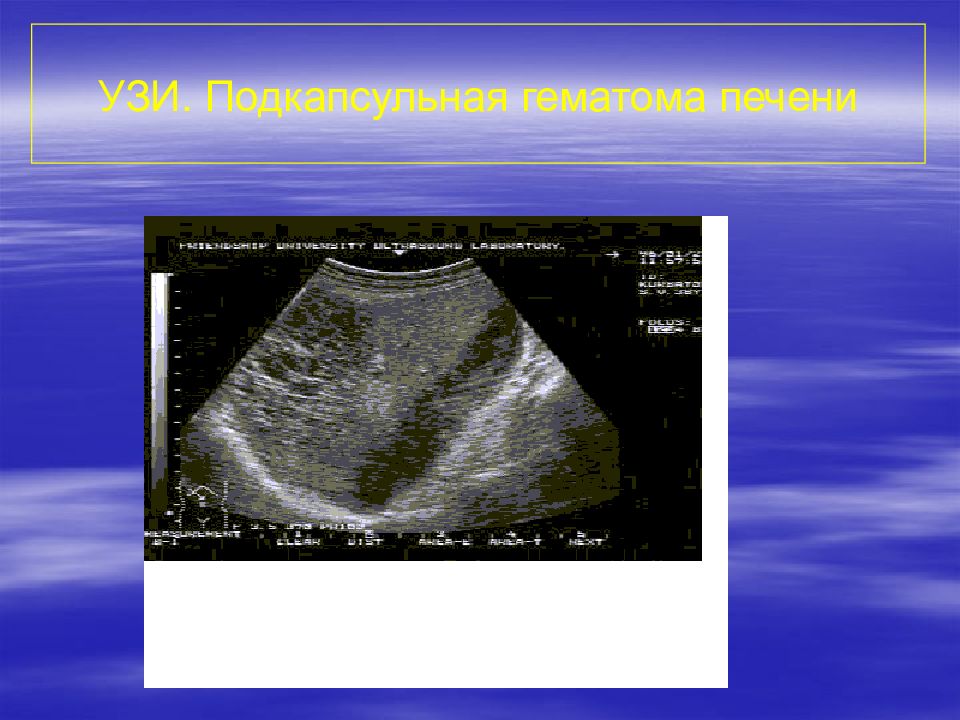 Ушиб печени. Подкапсульная гематома печени на УЗИ. Субкапсулярная гематома печени. Субкапсулярная гематома селезенки УЗИ. Подкапсульная гематома почки на УЗИ.