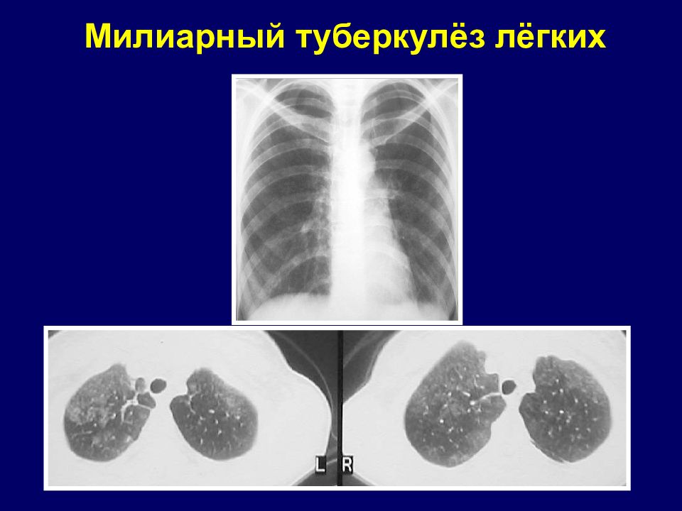 Внутренний туберкулез