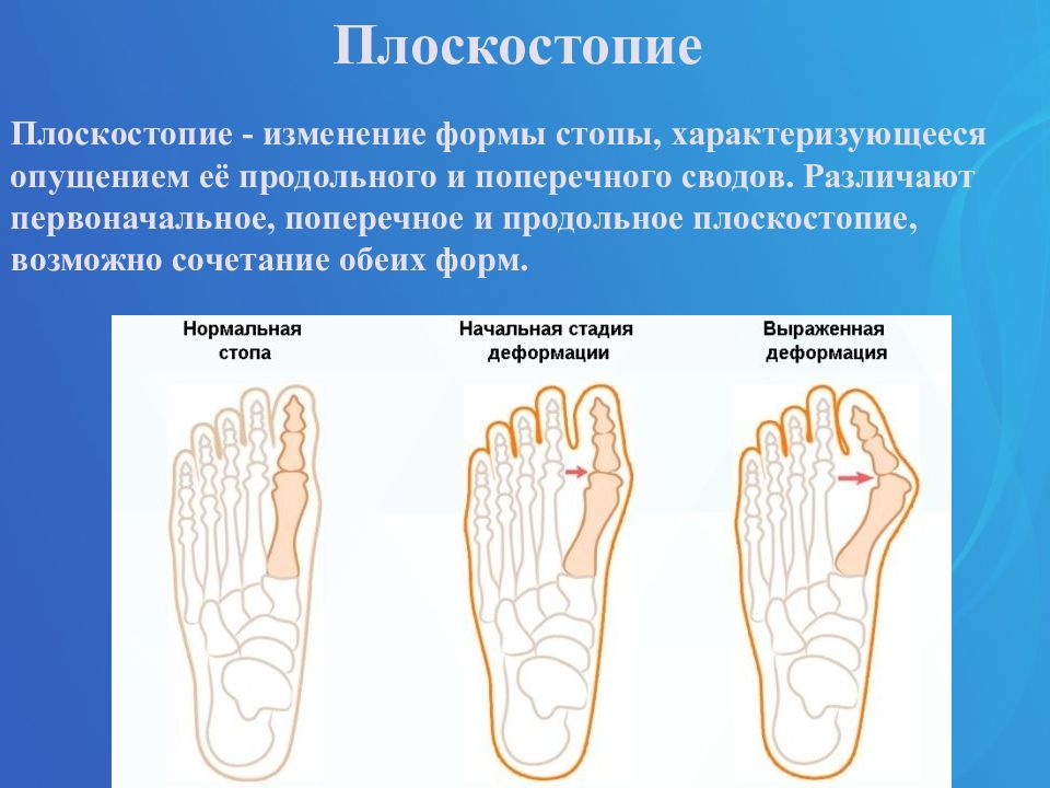 Плоская стопа код