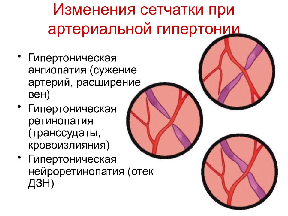 Гипертоническая ангиопатия презентация