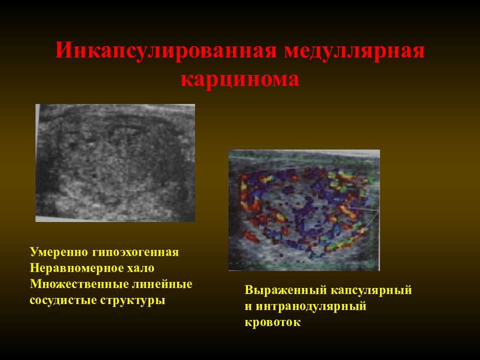 Интранодулярный кровоток узла щитовидной. Гипоэхогенное гетерогенное образование. Гипоэхогенное образование неоднородной структуры в щитовидной.